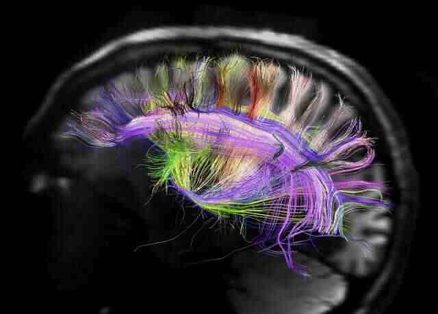 MRI do cérebro humano com cores.